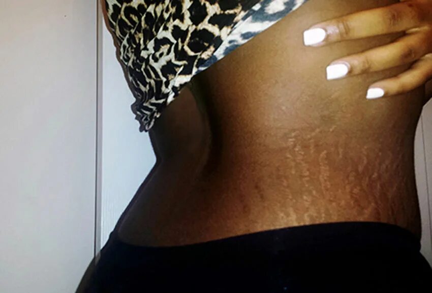 Растяжки stretch marks. Растяжки на черной коже. растяжки на загорелой коже.