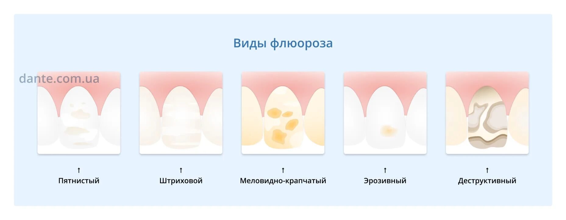 Классификация флюороза. Эндемический флюороз формы. меловидно крапчатая форма флюороза. деструктивная форма флюороза. формы гипоплазии эмали.