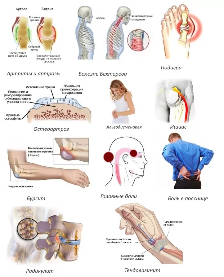 Артралгия что это. Миалгический синдром. Миалгия артралгия невралгия что это. Таблетки при артралгии. Миалгия классификация.