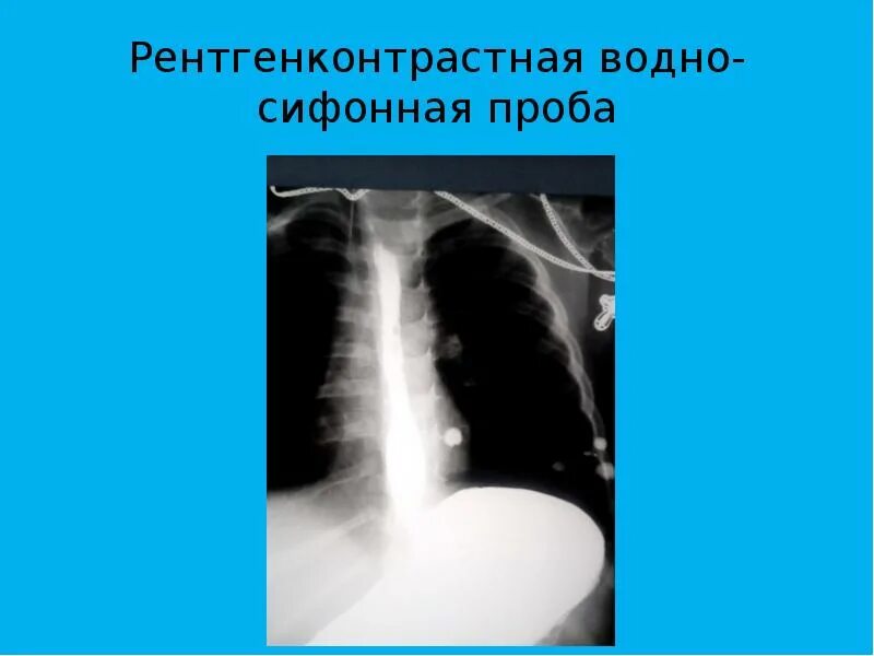 Водно сифонная проба желудка. УЗИ желудка водно-сифонная проба. УЗИ водно-сифонная проба детям. Водно сифонная проба при УЗИ желудка. Сифонная проба у ребенка УЗИ.