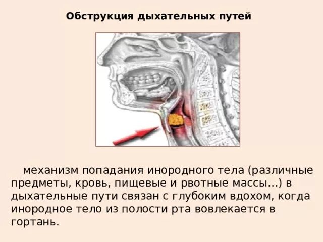 Приемы для освобождения верхних дыхательных путей. При полной закупорке инородным телом верхних дыхательных. Прием геймлиха. Неотложная помощь при инородном теле дыхательных путей алгоритм. Приём геймлиха при инородном теле.