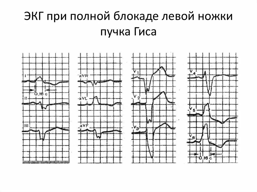 Блокада передне лнпг. ЭКГ при блокаде левой ножки пучка Гиса. Блокада левой ножки пучка Гиса на ЭКГ. Полная блокада ЛНПГ на ЭКГ. Полная блокада левой ножки пучка Гиса на ЭКГ.