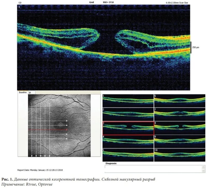 Макулярный разрыв после операции. Ламеллярный макулярный разрыв. Сквозной макулярный разрыв сетчатки операция. Ламеллярный макулярный разрыв сетчатки. Макулярный разрыв окт.