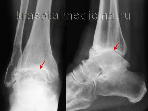 Остеоартроз голеностопного сустава рентген. Посттравматический артроз голеностопного сустава мкб 10. Крузартроз голеностопного сустава. Голеностопный артроз 2 степени.