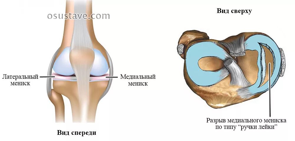 Типы разрывов мениска. Разрыв ручка лейки мениска коленного. Разрыв медиального мениска. Разрыв мениска коленного сустава ручка лейки. Разрыв рога внутреннего мениска.