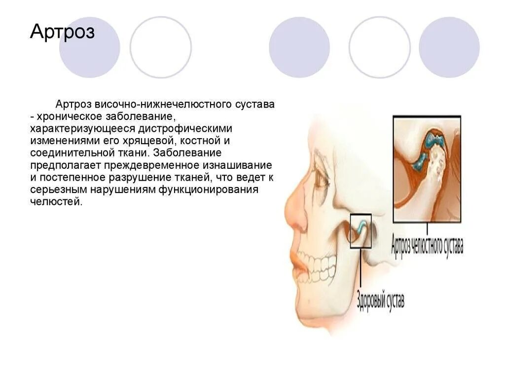 Артроз ВНЧС степени 1 рентген. Аксиографическое исследование ВНЧС. Деформирующий артрит ВНЧС.