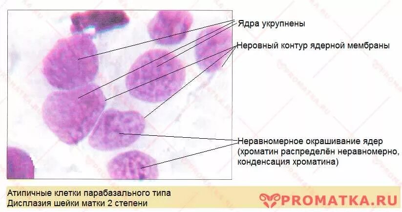 Дисплазия по цитологии. Дискариоз клеток плоского эпителия шейки. Дискариоз клеток плоского эпителия шейки. Тяжелая дисплазия цитология. Гиперплазия цитология.