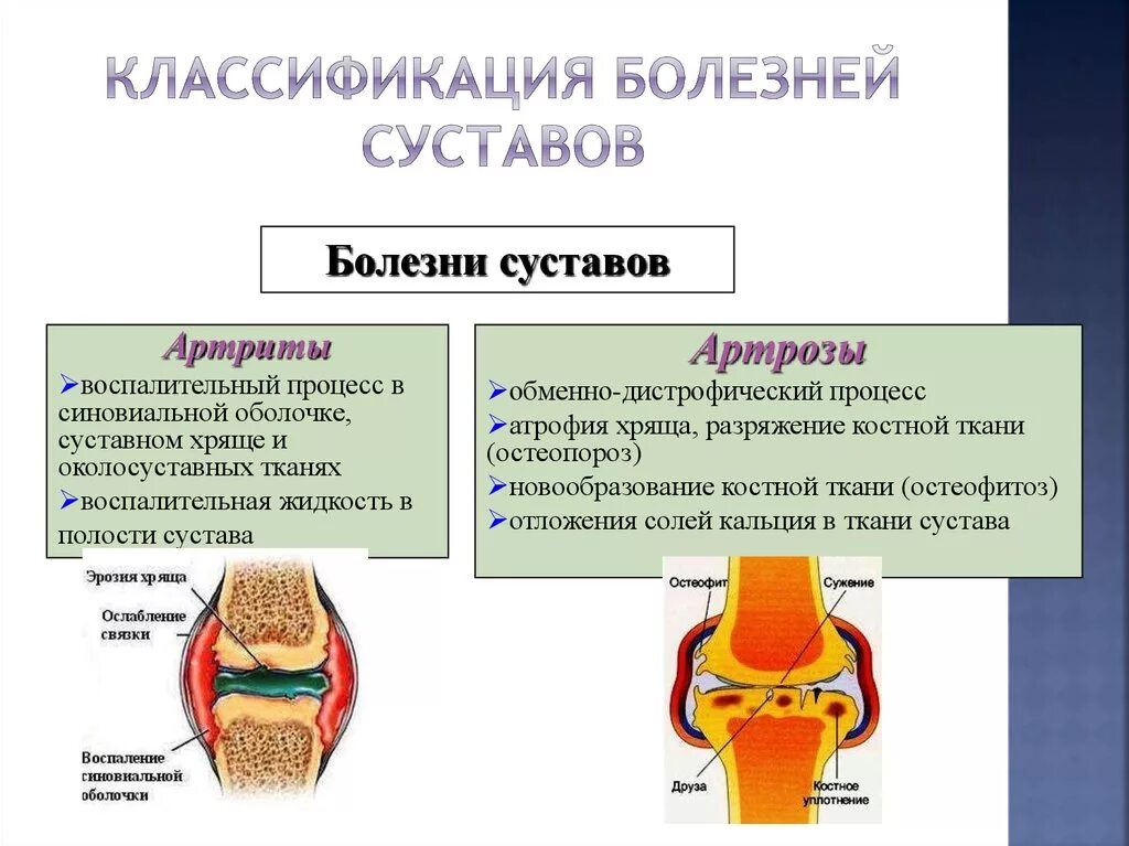 Типы артритов. Ревматоидный артрит классификация коленный сустав. Схема развития деформирующего остеоартроза. Болезни соединительной ткани ревматоидный артрит. Суставные поражения при ревматоидном артрите.