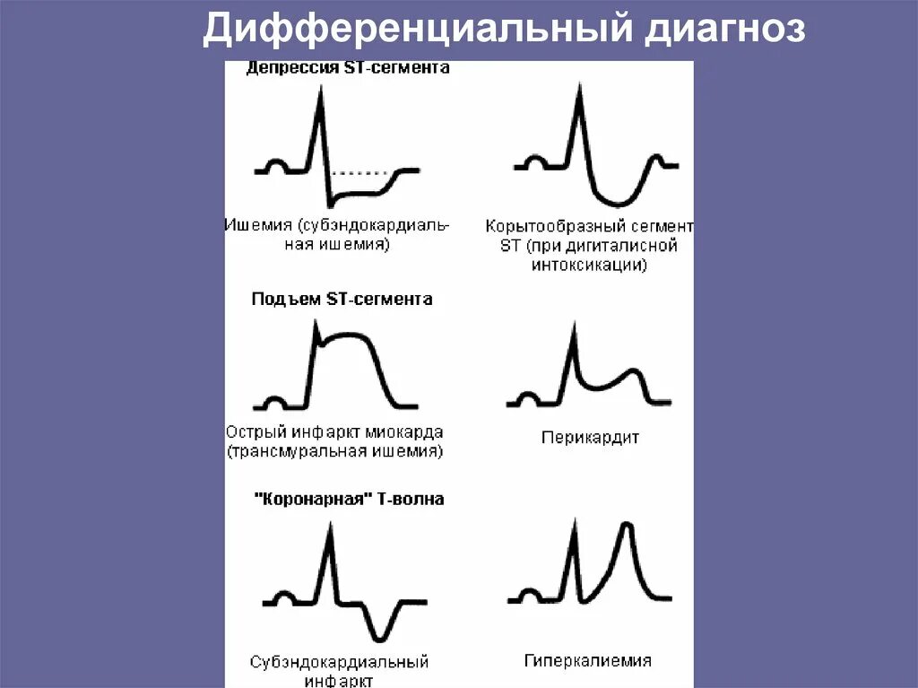 Косонисходящая депрессия St на ЭКГ. Депрессия сегмента St на ЭКГ v5 v6. Депрессия и элевация сегмента St. Косонисходящая депрессия сегмента St. Диффузные изменения экг что это значит