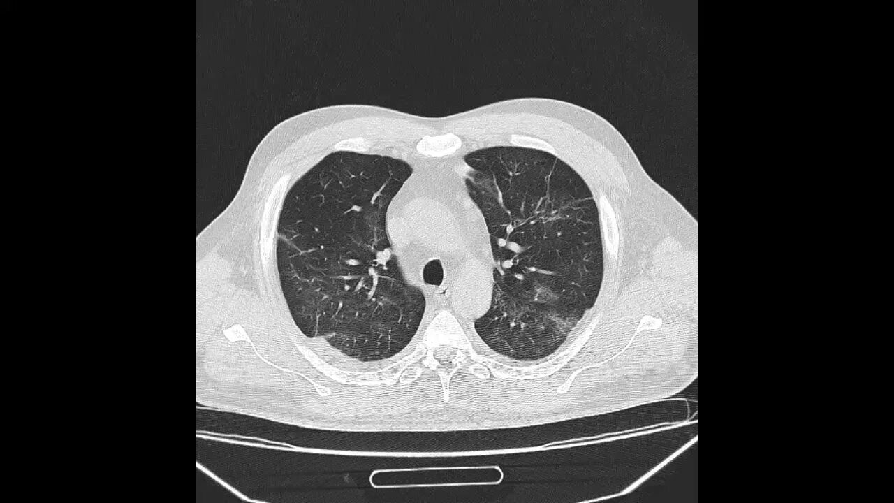 Компьютерная томография лёгких ковид 19. Кт легких ковид