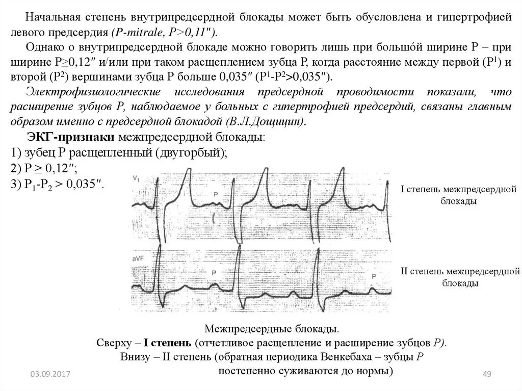 Что значит внутрипредсердная внутрипредсердная блокада. Двугорбый QRS на ЭКГ. Расщепление зубца s в v1. Двугорбый зубец т на ЭКГ. Внутрипредсердные блокады на ЭКГ.