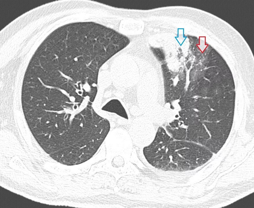 Кт легких ковид. Ковид пневмония кт. Консолидация пневмония кт. Параканкрозная пневмония на кт. Крупозная пневмония кт.