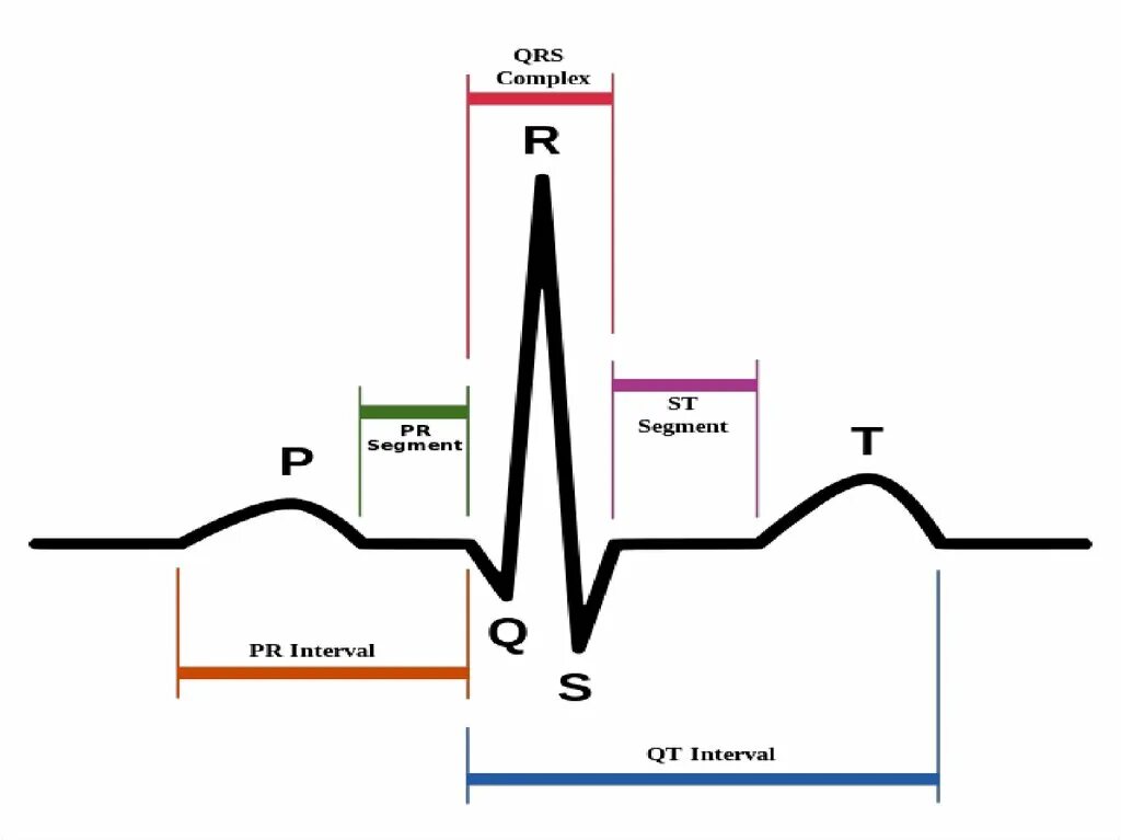 Комплекс QRS на ЭКГ. Длительность комплекса QRS на ЭКГ. Расширение комплекса QRS на ЭКГ. Интервал QRS на ЭКГ.