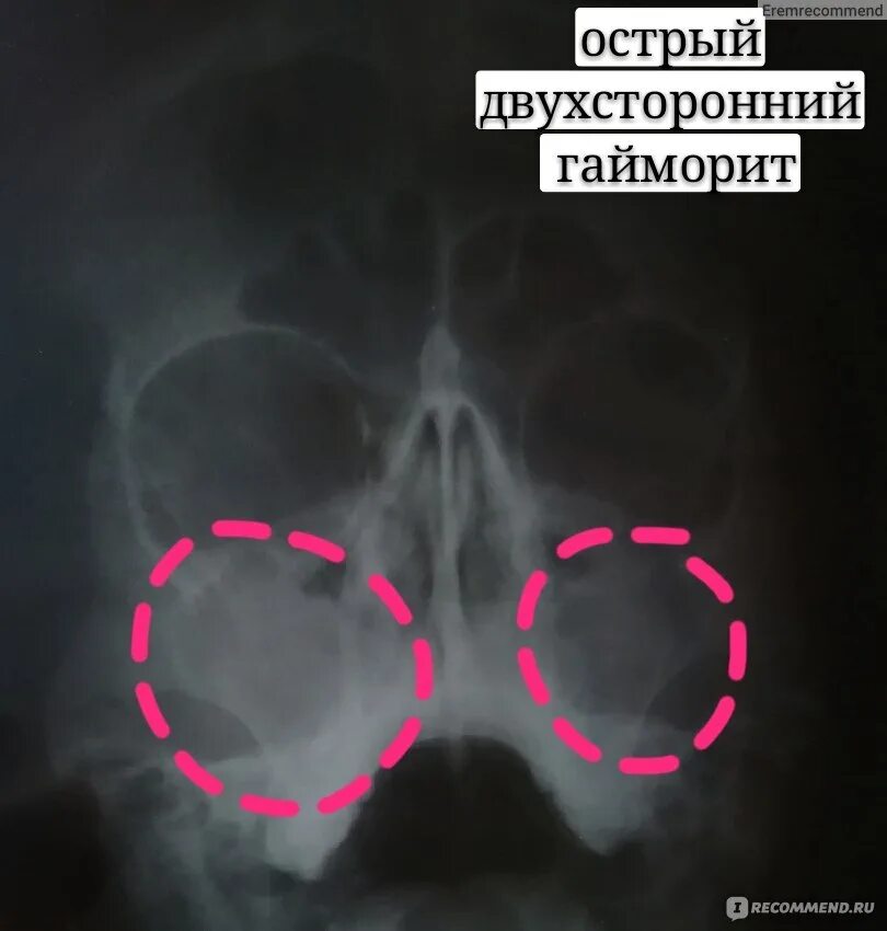 Гайморовы пазухи гайморит рентген. Рентген пазух носа гайморит. Рентген придаточных пазух носа фронтит. Двухсторонний верхнечелюстной синусит рентген.