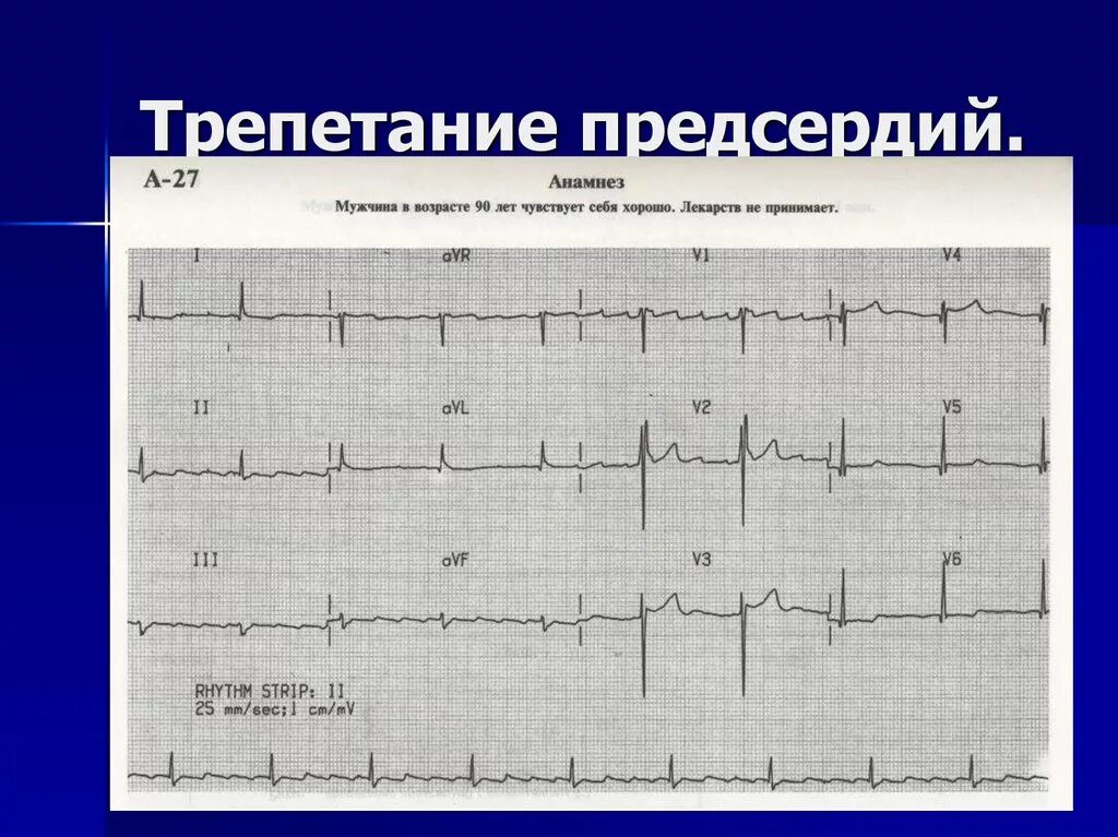 Трепетание предсердий 2 к 1 на ЭКГ. ЭКГ при трепетании предсердий. ЭКГ при трепетании предсердий правильная форма. Трепетание предсердий 3:1. Формы трепетания предсердий