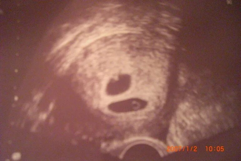 узи замершая беременность 5 недель. узи признаки неразвивающейся беременности. неразвивающаяся беременность на ранних сроках узи. 4 5 недели замершая беременность. неразвивающаяся беременность узи.