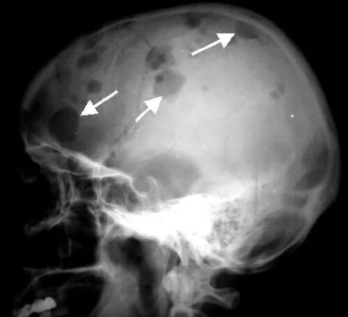Миеломная болезнь рентген черепа. Миеломная болезнь на кт черепа. Миеломная болезнь костей черепа. Метастазы в кости черепа на рентгене. Множественные злокачественные