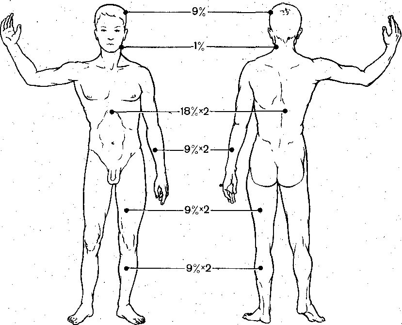 Определение площади ожогов. Определить примерно процент ожогового поражения тела человека. Определить примерно процент ожогового поражения тела человека. Определить примерно процент ожогового поражения тела человека. Площадь ожогов методом девяток.