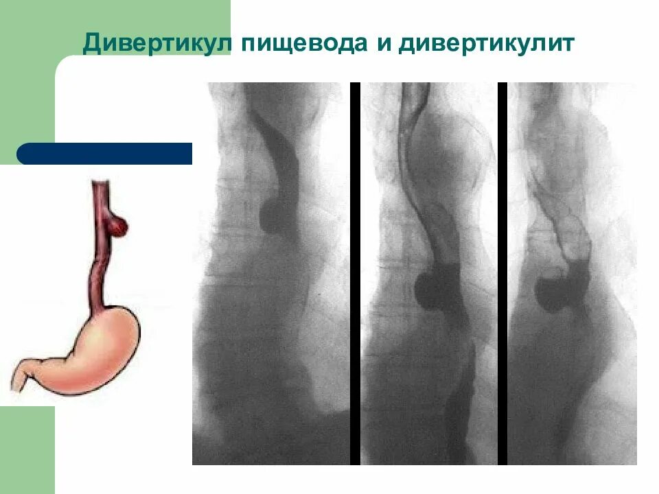 Год пищевода. Дивертикул пищевода Ценкера рентген. Пульсионные дивертикулы пищевода. Тракционный дивертикул пищевода. Тракционный дивертикул кишечника рентген.