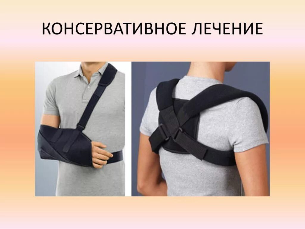 перелом ключицы. внесуставной перелом ключицы. повязка смирнова-вайнштейна техника. перелом ключицы у детей лечение. винтообразный перелом ключицы.