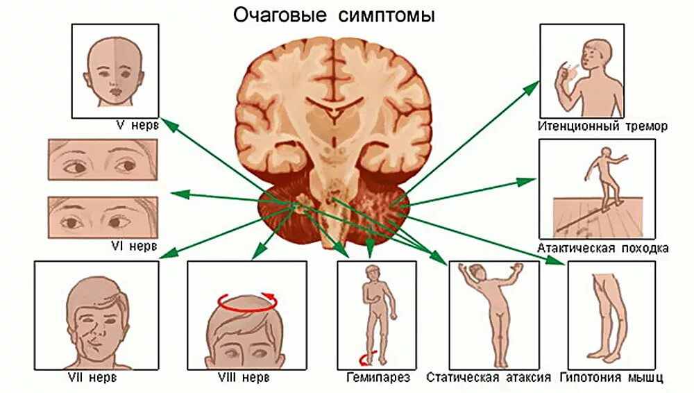 Очаговая неврологическая симптоматика менингит. Симптомы мозжечковой опухоли. Синдромы при опухолях головного мозга. Клинические симптомы поражения мозжечка.