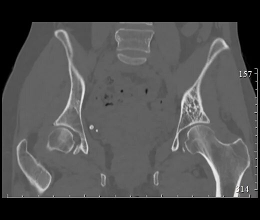 Кт подвздошной кости. Фиброзная дисплазия подвздошной кости на кт. Метастазы в подвздошной кости кт. Метастазы в кости таза кт. Гемангиома крыла правой подвздошной кости на кт.