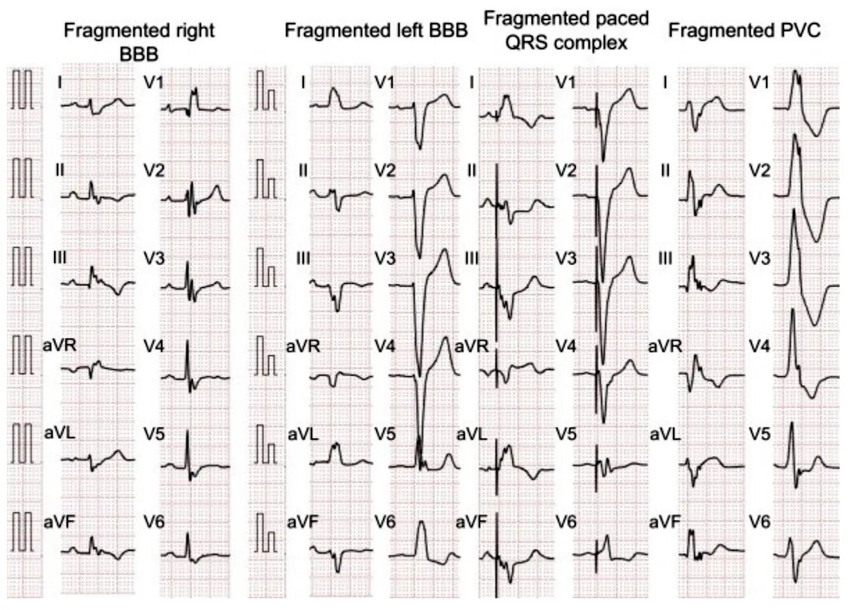 Расщепление зубца. Расщепление комплекса qrs на экг. раздвоение комплекса qrs на экг. отрицательный комплекс qrs в 3 отведении. уширенный комплекс qrs на экг.