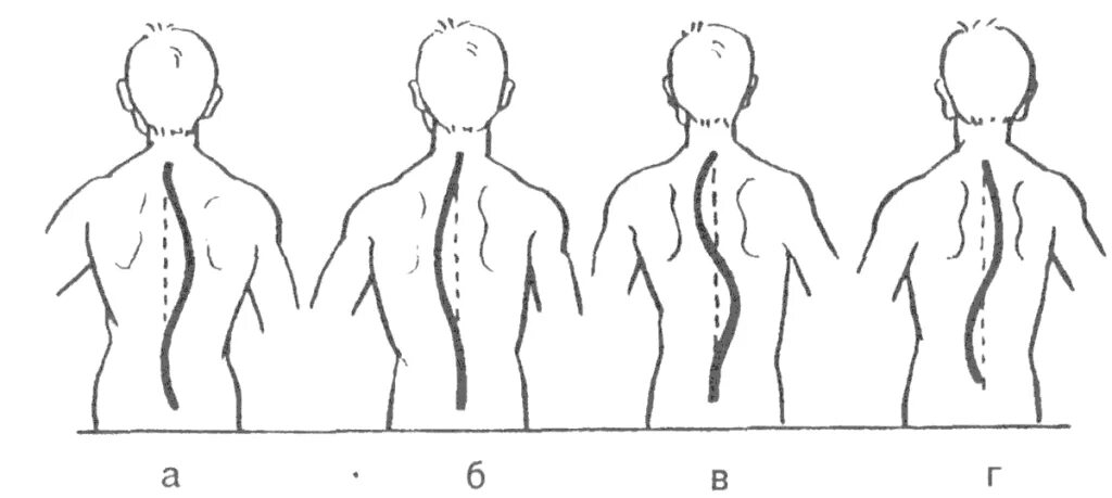 Асимметрия осанки. Асимметрия осанки. Деформация позвоночника, сколиоз. S образный сколиоз. Грудопоясничный сколиоз 3 степени s образный.