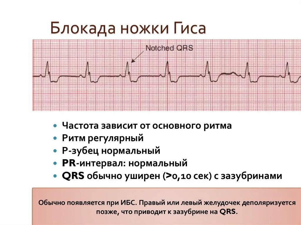 Что значит полная блокада. ЭКГ при АВ блокаде 2 степени. АВ блокада 2 степени Мобитц 3 на ЭКГ. АВ-блокада 2 степени Мобитц 1 Тип 2:1. Av блокада 2 степени Мобитц 2 на ЭКГ.