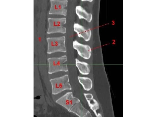 Позвоночник отдел l3 s1. Диски позвонков l3-l4, l4-l5, l5-s1. Межпозвонковые диски l1-s1. Протрузии диска l5-s1. Грыжа диска l3-s1.
