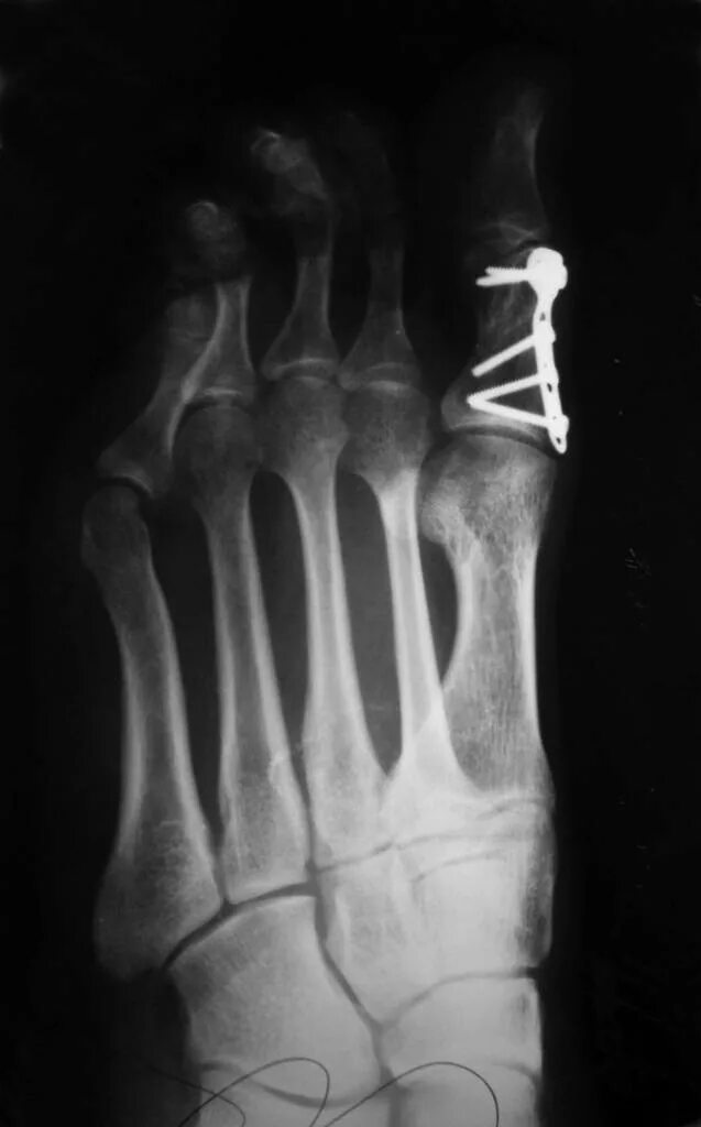 Трещина фаланги. Перелом основной фаланги 1 пальца стопы рентген. Перелом фаланги мизинца рентген. Экзостоз ногтевой фаланги 1 пальца стопы. Оскольчатый перелом мизинца.