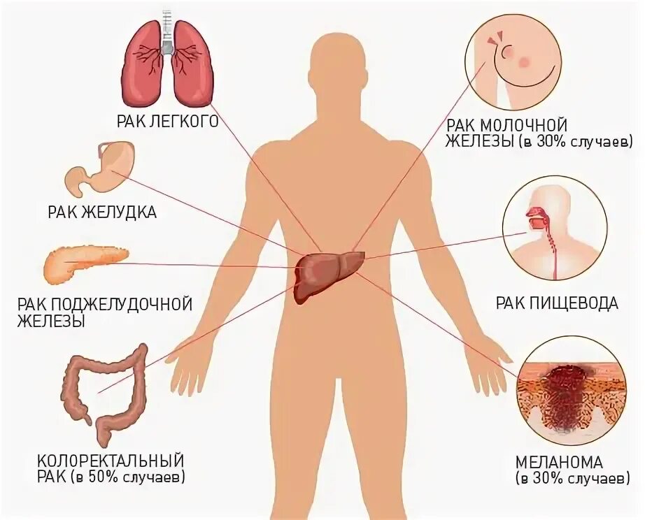 Признаки метастаз при раке. Метастатическое поражение печени. Печень и желудок онкология.