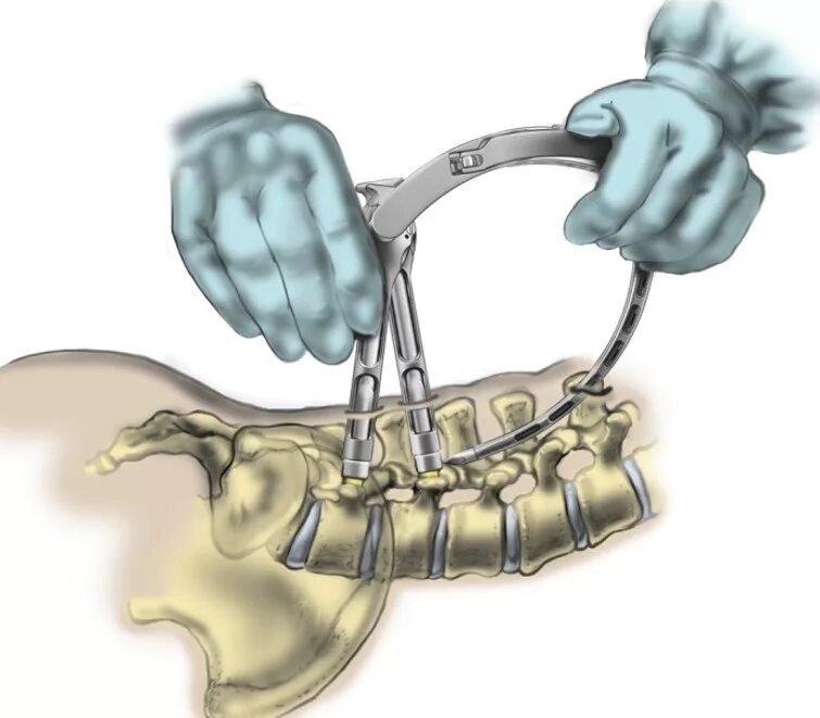 Операция транспедикулярная фиксация позвоночника. Транспедикулярный остеосинтез. Остеосинтез позвоночника l1 транспедикулярной. Транскутанная транспедикулярная стабилизация позвоночника. Конструкция позвоночника операция