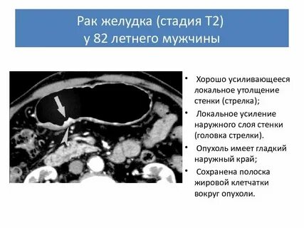 Операция рака желудка 4 стадия