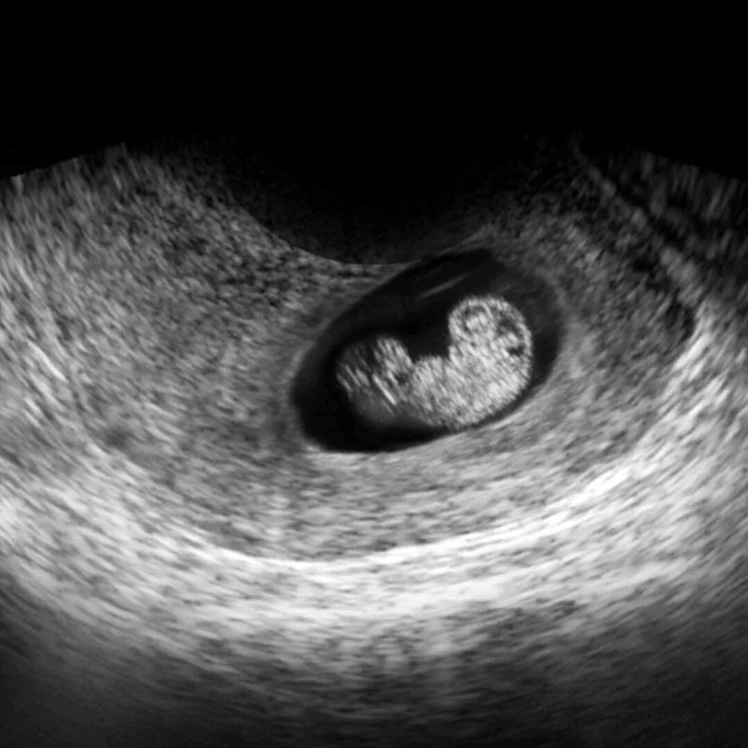 7 weeks. Эмбрион на 7 неделе беременности УЗИ. Беременность 7 недель фото эмбриона на УЗИ. УЗИ 7 недель беременности. УЗИ на 7 акушерской неделе беременности.