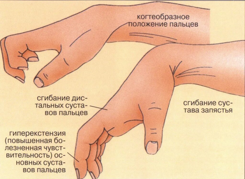 Почему пальцы можно. Контрактура лучезапястного сустава. Симптомы повреждения запястья.