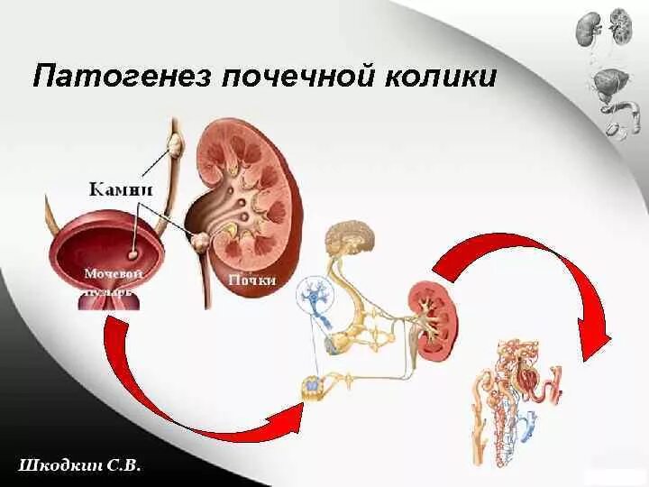 Мочекаменные колики