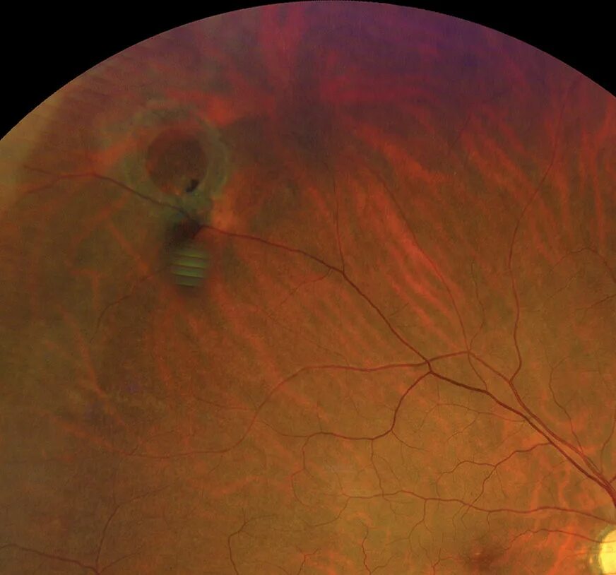 Ретиношизис дистрофия сетчатки. Буллезный ретиношизис. Периферический буллезный ретиношизис. Макулярный ретиношизис. Повреждение сетчатки