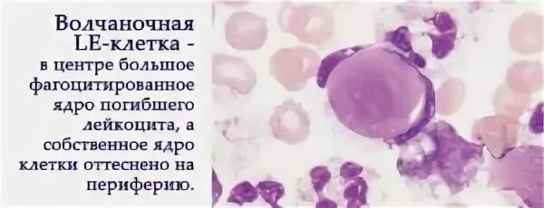 Системная красная волчанка le клетки. Le-клетки или клетки красной волчанки le-феномен. Le-клет клеток системной красной волчанки.