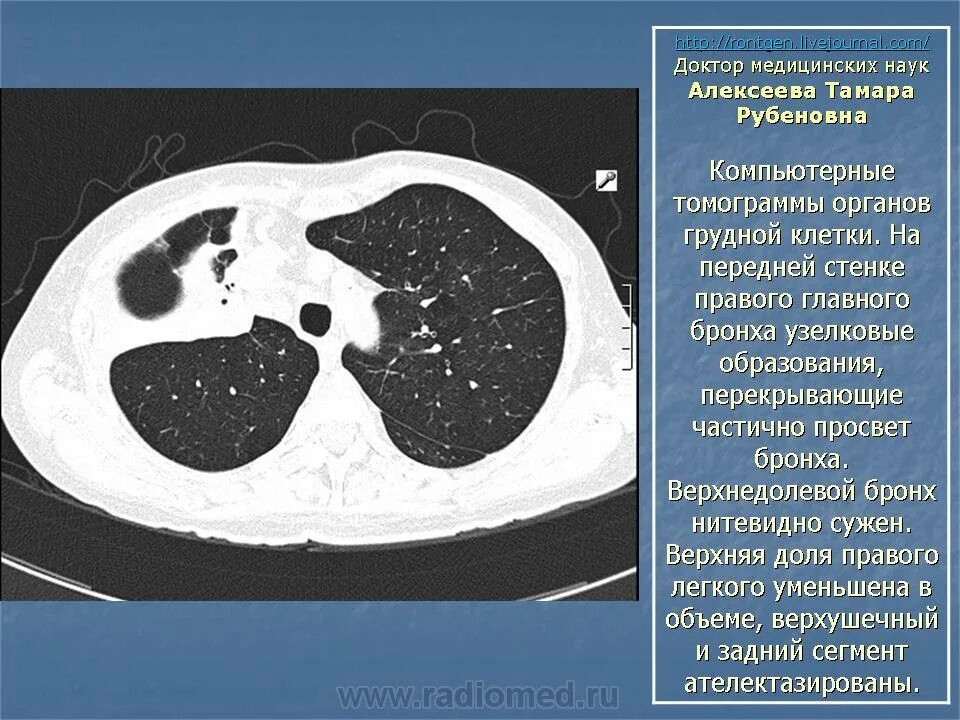 Лимфаденопатия на кт легких. Туберкулез внутригрудных лимфатических узлов кт. Лимфатические узлы грудной клетки кт. Как лечить внутригрудную лимфаденопатию