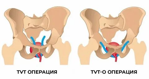 Пролапс недержание мочи