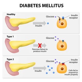 Main types of diabetes mellitus. 