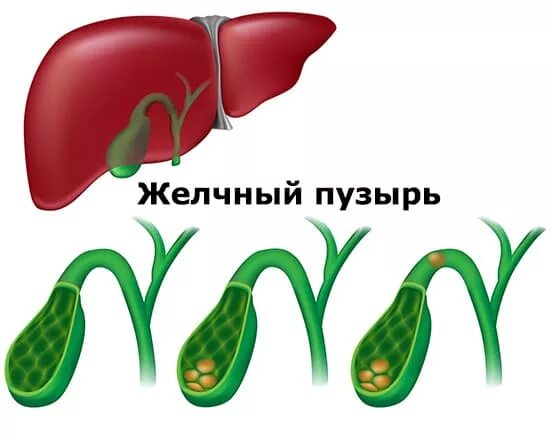 Перегиб протока желчного пузыря. Изогнутая форма желчного пузыря. Перегиб желчного пузыря в с/3. Форма желчного пузыря с перегибом. Желчный изгиб у ребенка