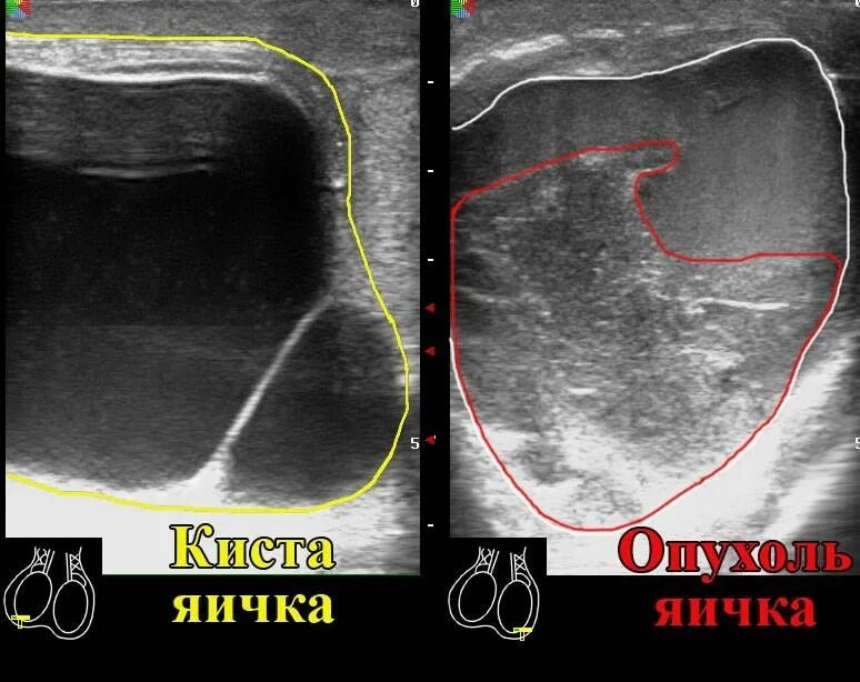 Ультразвуковое исследование органов мошонки. Яичко на ощупь