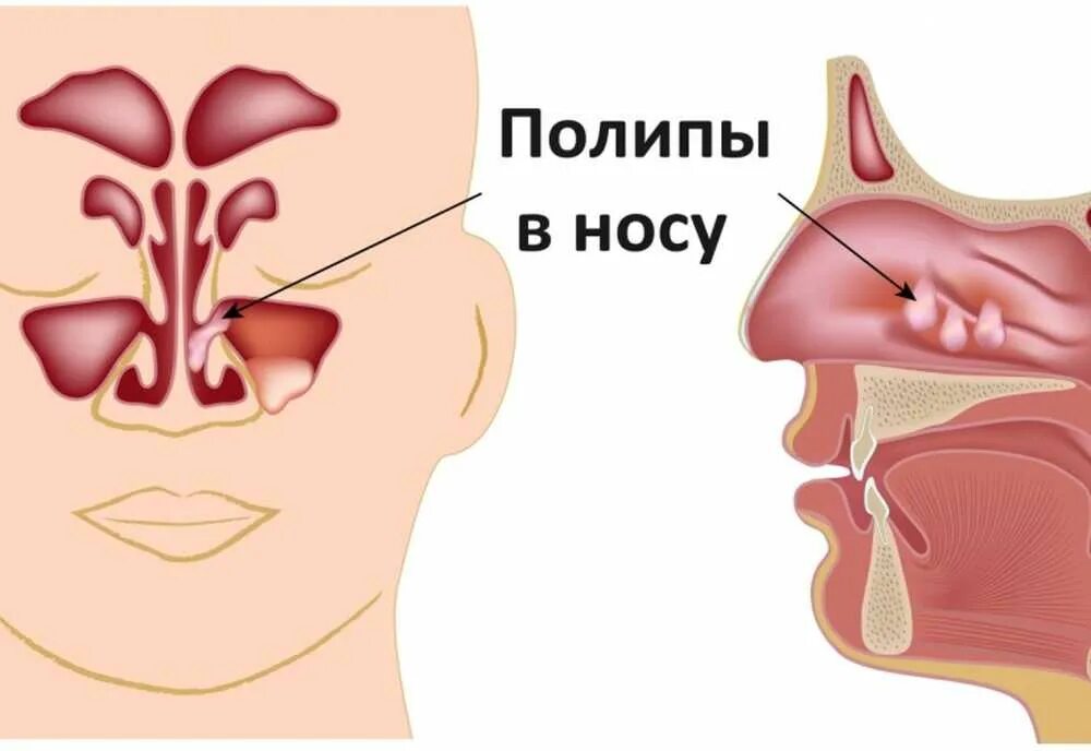 Дышит ртом соплей нет. Полипозный риносинусит.