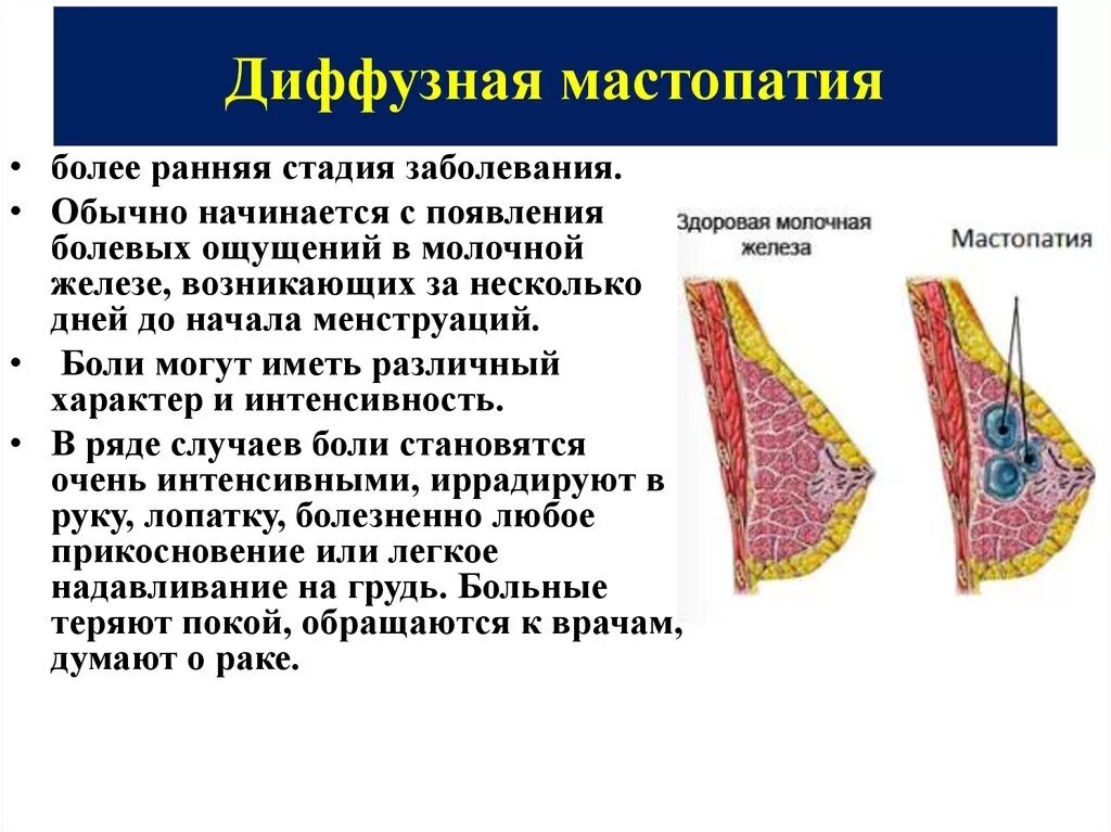 Диффузно фиброзное изменение молочной железы. Фиброзно-кистозная мастопатия. диффузная фиброзно-кистозная мастопатия. диффузная мастопатия молочных желез. фиброзно-кистозная мастопатия молочной железы.