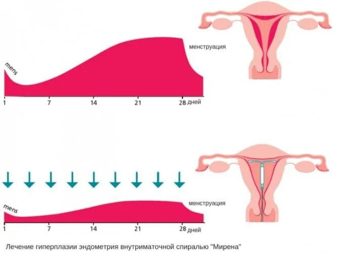 Почему месячные 11 дней. Менструации эндометрия. Менструация с эндометрием.