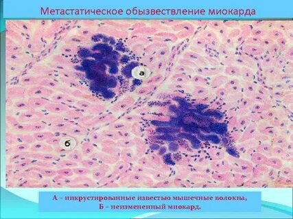 Дистрофический очаг