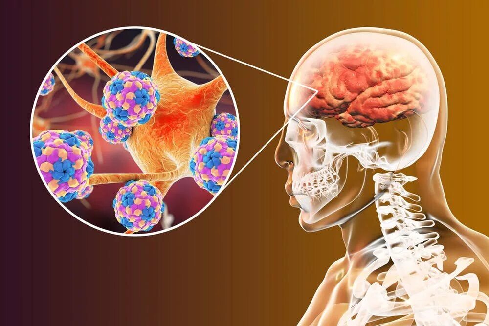 Полиомиелит поражение мозга. Поражение головного мозга при полиомиелите. Вирусы поражающие мозг.