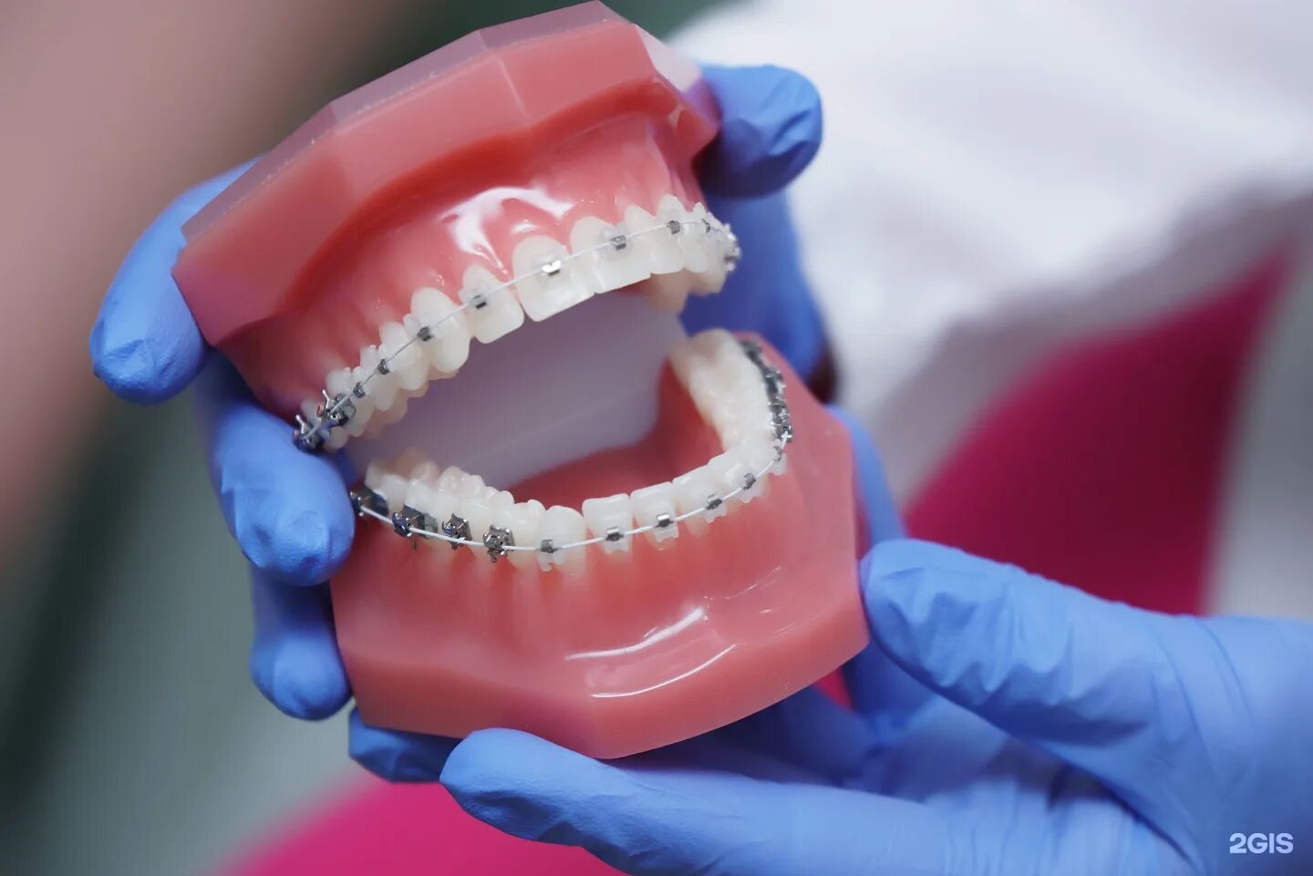 Еда после брекетов. Еда после брекетов. Элайнеры invisalign. Еда после брекетов. Брекеты damon q.